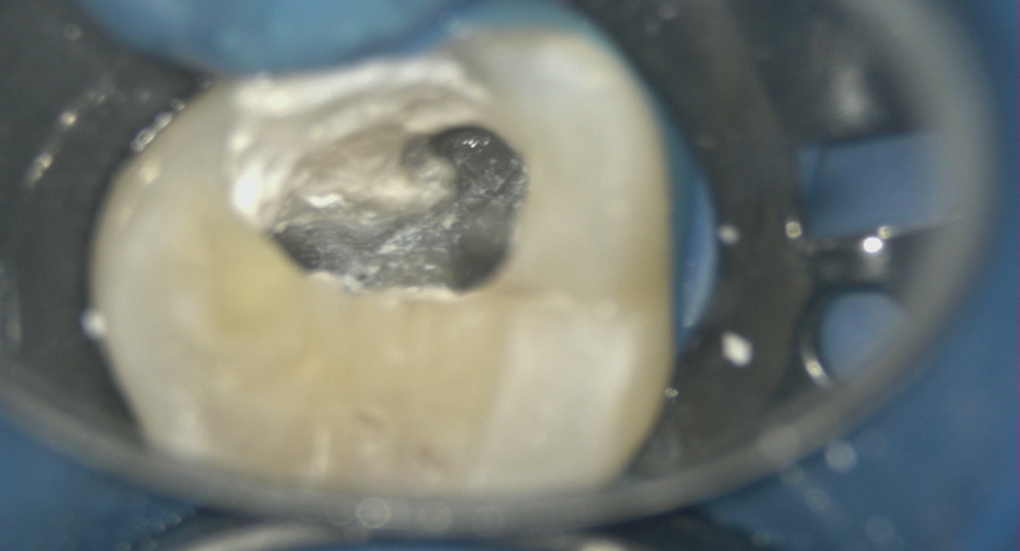 実際の歯科マイクロスコープで見た様子　写真2